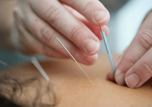 Emergent Healing Three Prong Acupuncture