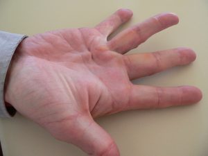 Dupytren afflicted hand in pain in need of Emergent Healing